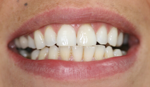 A close up of a Cheshire based Freedom Dental patient's teeth after Tooth Whitening