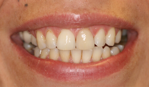 A close up of a Cheshire based Freedom Dental patient's teeth before Tooth Whitening