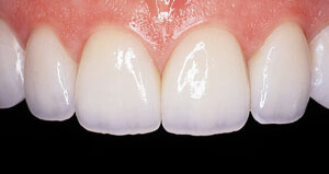 Freedom Dental Emax Veneers After