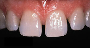 Freedom Dental Emax Veneers Before